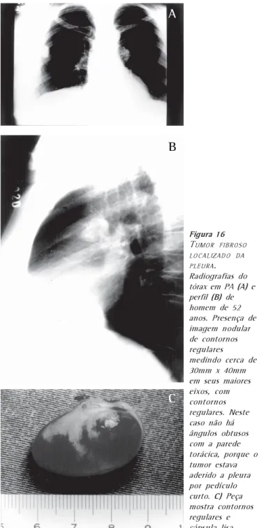 Figura 16 T UMOR FIBROSO LOCALIZADO DA PLEURA . Radiografias do tórax em PA (A)  e perfil  (B) de homem de 52 anos