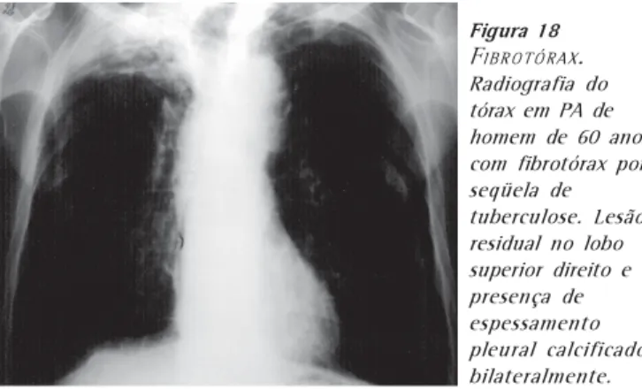 Figura 18 F IBROTÓRAX . Radiografia do tórax em PA de homem de 60 anos com fibrotórax por seqüela de tuberculose