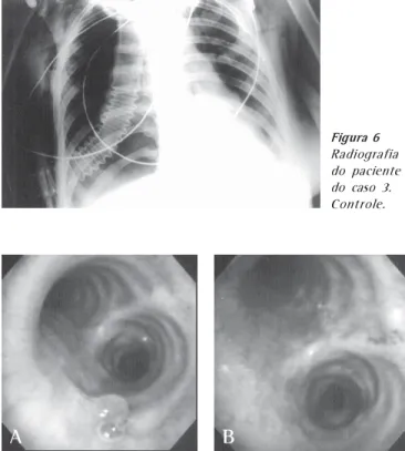 Figura 7 – Broncoscopia do paciente do caso 3 no 3º mês de pós- pós-operatório.  A) Granuloma de 5mm na parede brônquica