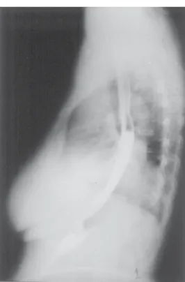 Figura 4 – Infiltrado de células atípicas no parênquima pulmonar, ar- ar-redondadas ou ovaladas,  com arranjo organóide, por vezes dispostas perpendicularmente em relação aos espaços vasculares –  Hemangio-pericitoma