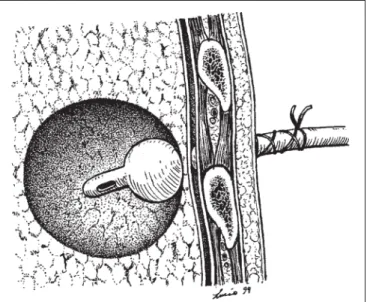Figura 4 – O balonete da sonda de Folley é insuflado e a mesma é tracionada e fixada hermeticamente à parede torácica
