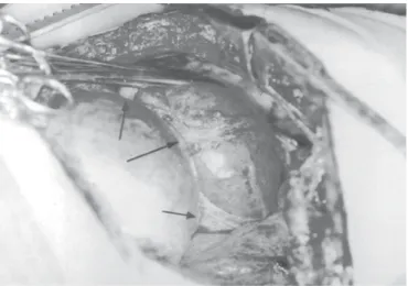 Figura 1 – Tomografia computadorizada do tórax mostrando enfi- enfi-sema subcutâneo da parede lateral esquerda, hidropneumotórax, atelectasia do lobo inferior e hérnia diafragmática esquerda