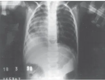 Figura 1 - Radiografia de tórax revelando hipoplasia pulmonar à direita, imagem tubuliforme tortuosa em projeção de hemitórax direito (sinal da cimitarra), desvio de traquéia para a direita e  pin-çamento dos espaços intercostais