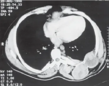 Figura 1 Radiografia de arcos costais mostrando lesão insuflante na sétima costela