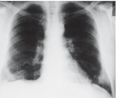 Figura 2 – Radiografia simples do tórax na admissão hospitalar mostrando opacificação na base direita e infiltrado não  homogê-neo na base esquerda