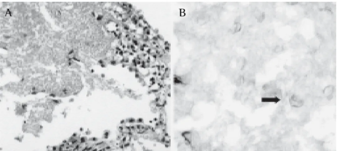 Figura 3 – Microscopia óptica do pulmão. A) exsudato alveolar de aspecto espumoso (hematoxi- (hematoxi-lina-eosina, 40x)