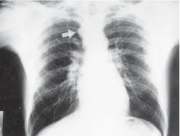 Figura 1 – Radiografia de tórax em PA. Alargamento do contorno direito do mediastino superior (seta).