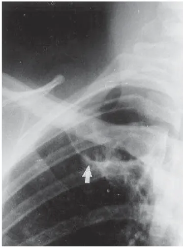 Figura 6 – Radiografia de tórax em PA. Opacidades heterogêneas em campo superior de ambos os pulmões com cavitações (setas).