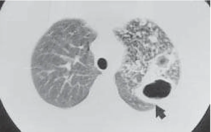 Figura 11 – TC de tórax. Cavitação de paredes espessas em pulmão esquerdo (seta). Notar nódulos centrolobulares também sugestivos de atividade da doença.