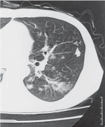Figura 19 – TC de tórax. Bronquiectasias de tração em pulmão es- es-querdo (seta). Notar também aspecto em mosaico em ambos os pulmões.