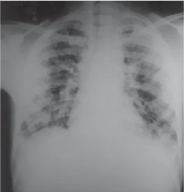Figura 2 – Pneumonia por Chlamydia psittaci. Radiografia de tórax do paciente no CTI, em ventilação mecânica, com quadro de SARA (síndrome da angústia respiratória aguda) já estabelecido.