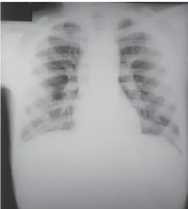 Figura 3 – Pneumonia por Chlamydia psittaci. Radiografia de tórax do paciente em alta hospitalar, mostrando melhora significativa do quadro  pulmonar.