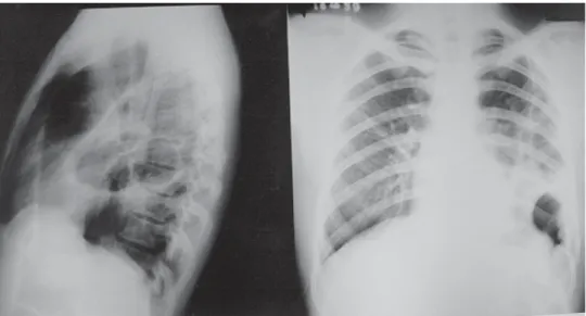 Figura 2 – Radiografia de tórax em PA e perfil esquerdo: empiema crônico em base do HTE e cistos pulmonares remanescentes.