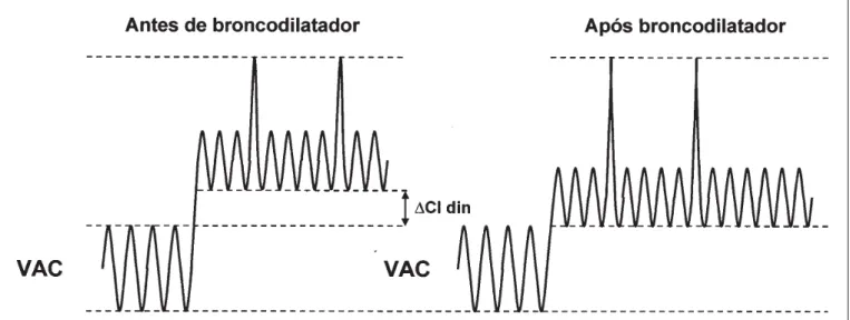 Figura 1 – Aumento da “capacidade inspiratória dinâmica” após Bd, na manobra de VVM por efeito de redução da hiperinsuflação