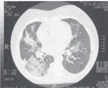 Figura 3  – Tomografia computadorizada de tórax de uma paciente com pneumonia em organização manifestando-se como  consoli-dação única localizada