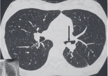 Figura 2 – A) Representação esquemática de tumor envolvendo a carena secundária; B) broncoplastia com neocarena.