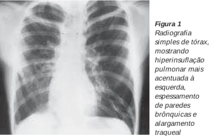 Figura 1 Radiografia simples de tórax, mostrando hiperinsuflação pulmonar mais acentuada à esquerda, espessamento de paredes brônquicas e alargamento traqueal