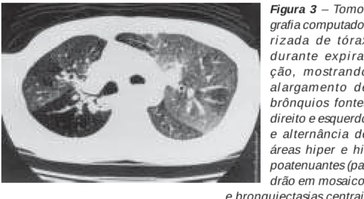 Figura 2 – Tomografia computadorizada de tórax durante inspira- inspira-ção (imagem à esquerda) e expirainspira-ção (imagem à direita),  mostran-do alargamento traqueal e colabamento na fase expiratória