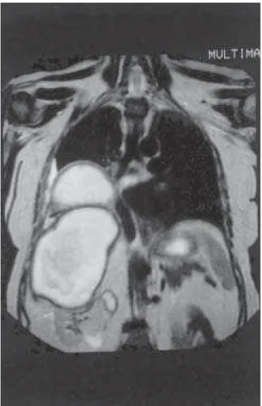 Figura 2 – Ressonância magnética (plano sagital): observar fígado rechaçado anteriormente pelo grande abscesso retroperitoneal, abscesso pulmonar e derrame pleural.