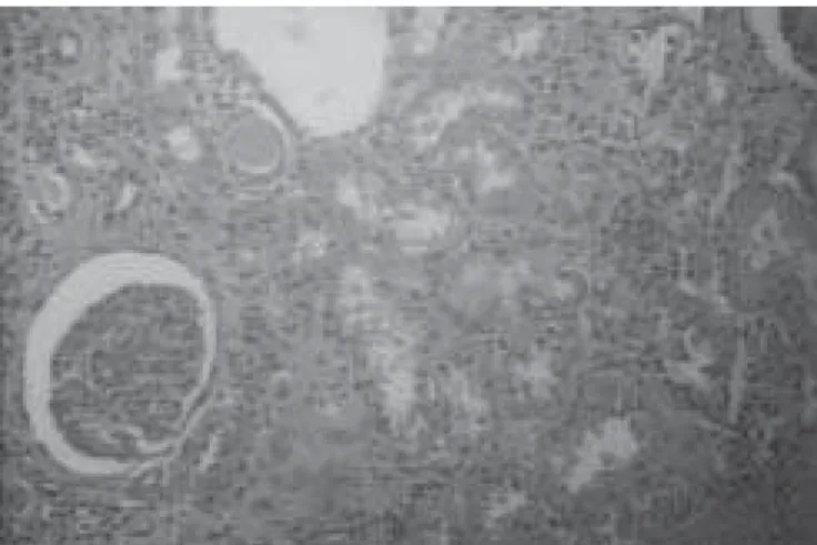 Figura 3 – Microscopia óptica de rim direito evidenciando pielone- pielone-frite xantogranulomatosa