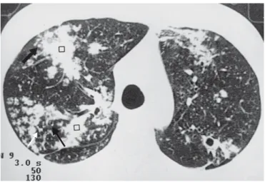 Figura 1 – TCAR. Múltiplos focos de condensação dispersos pelo parênquima pulmonar (quadrado), com nódulos do espaço aéreo (seta grossa), nódulos centrolobulares (seta fina) e preenchimento bronquiolar adjacente (seta vazada)