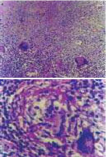 Figura 2 – Cérebro sediando processo inflamatório crônico granu- granu-lomatoso, com extensões de necrose caseosa, marginada por  célu-las epitelióides e gigantes tipo Langhans e corpo estranho, além de halo linfocitário – HE, 100x (a) e 400x (b).