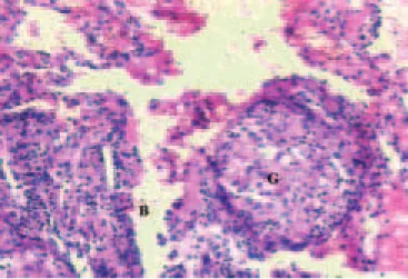 Figura 4 – Aspecto histopatológico da lesão pulmonar mostrando inflamação granulomatosa crônica (G), sem necrose central,  for-mando nódulos grosseiros de limites imprecisos com coroa  linfocitá-ria maldefinida localizado no interstício próximo a bronquíol
