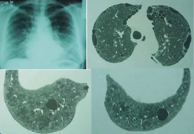 Figure 4. Chest X-ray (above, left) showing reticular diffuse infiltrate and ground-glass patterns in the lung bases