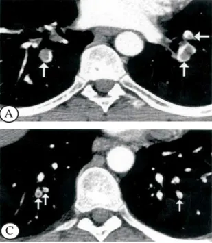 Figura 6A- TC espiral em multidetector com reconstruções multiplanares no TEP agudo.A reformatação sagital demonstra falha de enchimento parcial na artéria pulmonar interlobar direita com extensão para a artéria pulmonar do lobo inferior.