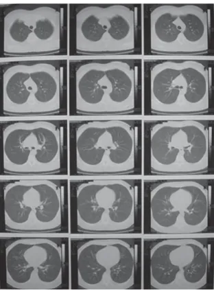 Figura 2. Tomografia computadorizada de tórax realizada sete dias após alta da UTI, mostrando normalidade do parênquima pulmonar