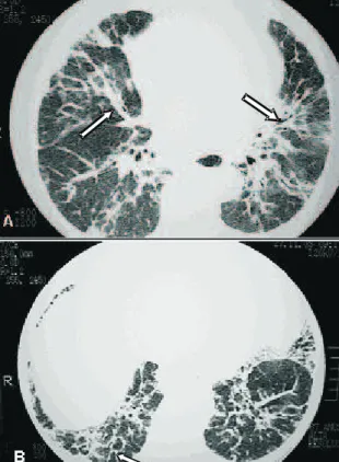 Figura 8. Opacidades reticulares. Sarcoidose pulmonar com espessamento septal nos lobos superiores, formando arcadas poligonais (setas), simulando linfangite carcinomatosa