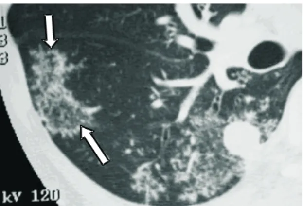Figura  18.  Sinal  do  anel  de  fada.  Micronódulos  de distribuição  anelar  (setas)  envolvendo  parênquima pulmonar relativamente poupado