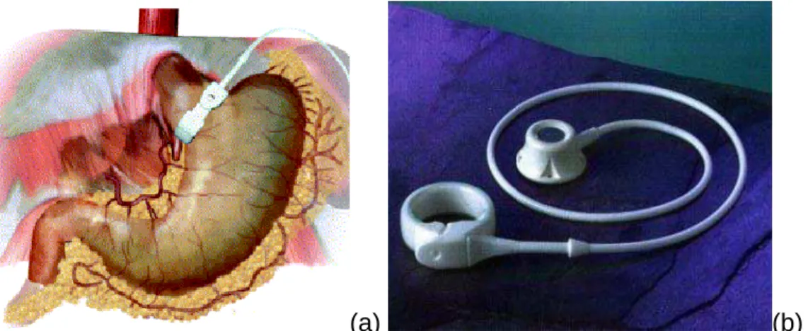 Figura 2.2-3 - Banda Ajustável por Laparoscopia (técnica restritiva) – (FISHER; SCHAUER,  2002) – (a) posicionamento da banda de contenção no estômago