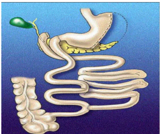 Figura 2.2-5 - Derivação Biliopancreática (Duodenal Switch) – técnica disabsortiva.  www.asbs.org 