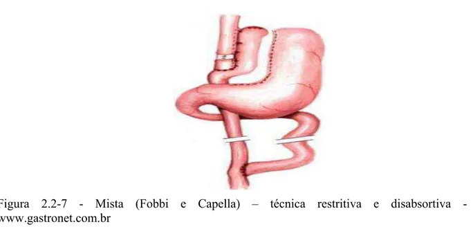 Figura 2.2-7 - Mista (Fobbi e Capella) – técnica restritiva e disabsortiva -  www.gastronet.com.br 