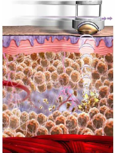 Figura 1. Tecnologia do ultra-som estético focalizado. O ultra- ultra-som focalizado a uma distância de aproximadamente 1,5 cm  proporciona a ruptura das células do tecido adiposo subcutâneo  (Coleman e col., 2009)