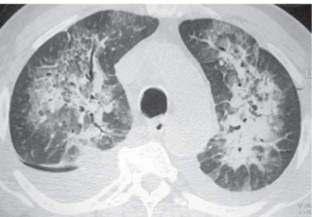 Figura 1 - Tomografia computadorizada de alta resolução, com corte nas bases pulmonares, com janela de pulmão, em paciente com insuficiência cardíaca congestiva, mostrando opacidades em vidro fosco e espessamento septal interlobular liso, com padrão de pav