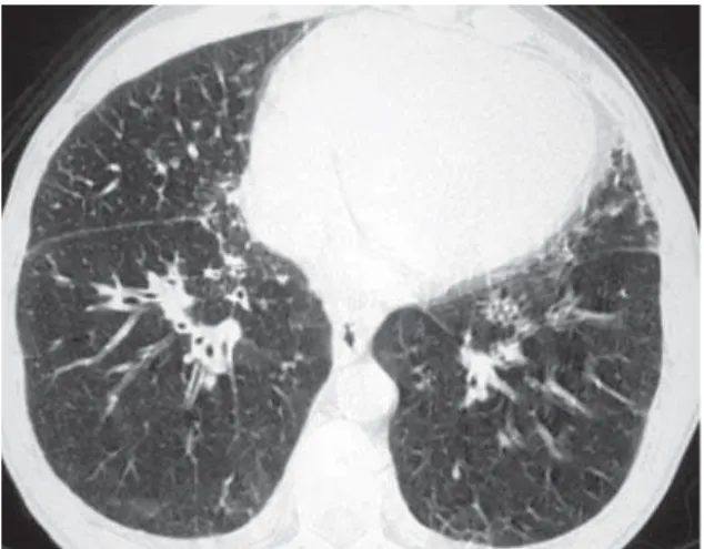 Figura 4 - Tomografia computadorizada de alta resolução, com corte no terço inferior dos pulmões, com janela de pulmão, mostrando espessamento do interstício peribroncovascular e discreto espessamento de septos interlobulares, mais evidente no lobo médio