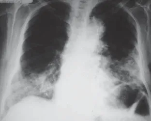 Figura 1 - Radiografia simples do tórax em póstero-anterior, mostrando opacificações bilaterais, de predomínio basal