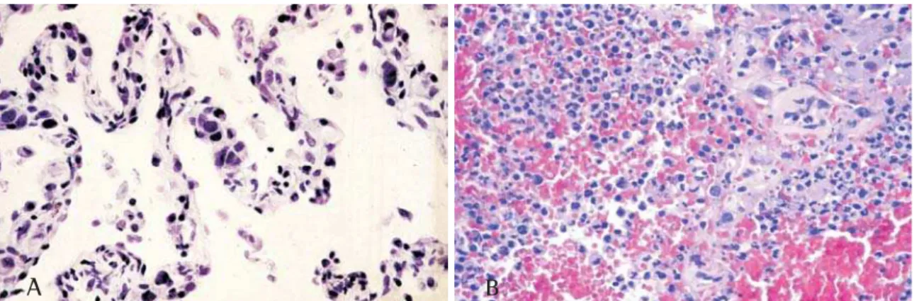 Figura 2 - Dano alveolar difuso induzido pelo vírus herpes simples. A) Efeito citopático nuclear nos pneumócitos tipo II (setas) (H &amp;  E, ×400)