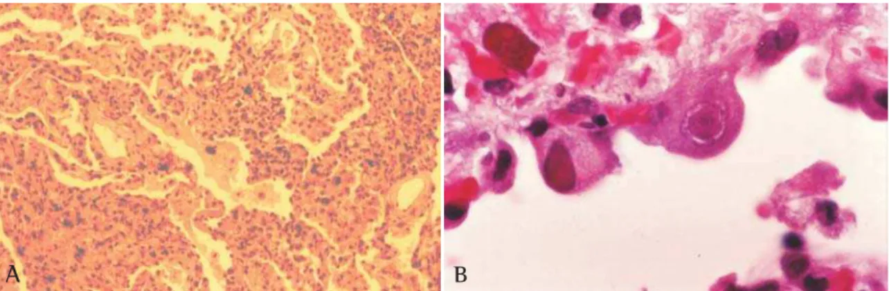 Figura 4 - A) Envolvimento pulmonar na malária (H &amp; E ×40). B) Pneumonia por citomegalovírus (H &amp; E ×400)