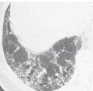 Figura 2 -   Vista pouco aumentada de um espécime patológico de biópsia pulmonar cirúrgica mostrando um padrão geograficamente e temporalmente heterogêneo de lesão pulmonar com áreas de fibrose subpleural densa e faveolamento adjacente a áreas de caracterí