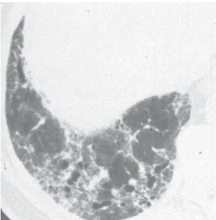Figure 2 -   Low-power magnification view of a pathologic specimen from a surgical lung biopsy showing a geographically and temporally heterogeneous pattern of lung injury with areas of dense subpleural fibrosis and honeycombing adjacent to areas of normal