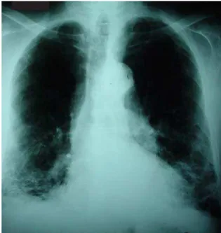 Figura 1 -  Radiografia de tórax com infiltrado intersticial retrátil em bases pulmonares e aumento difuso da  transpa-rência pulmonar em campos médios e superiores