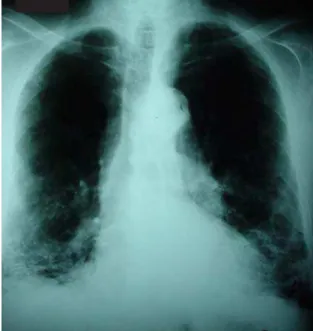Figure 1 - Chest X-ray with retractile interstitial infiltrate in the lung bases and diffuse increase in pulmonary transparency in the upper and middle lobes