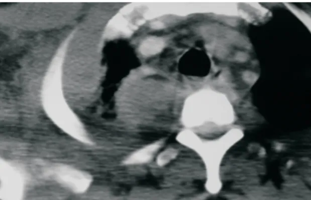 Figura 1- Radiografia de tórax evidenciando imagem de hipotransparência, justamediastinal, em hemitórax superior direito