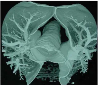 Figure 3 - Computed tomography of the chest with multiplane three-dimensional reconstruction revealing the abnormal dimensions of the trachea and main bronchi
