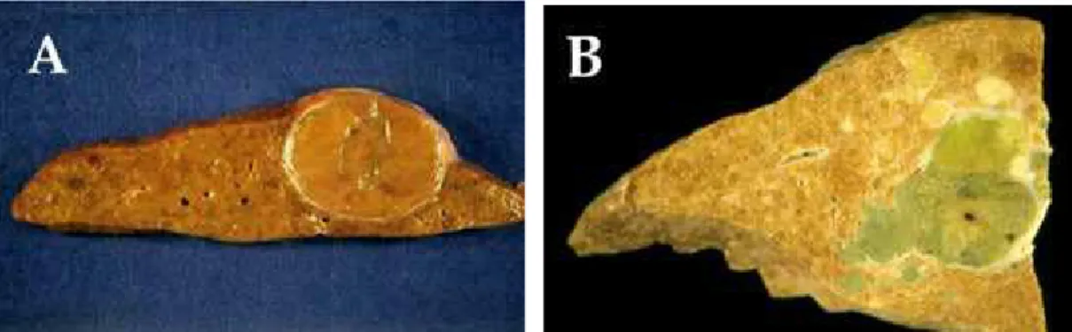 Figura  12  –  Carcinoma hepatocelular. Imagem macroscópica de um  carcinoma encapsulado (A) e associado com múltiplos nódulos  metastásicos (B) após a ruptura da cápsula fibrosa (RAOUL,  2008)