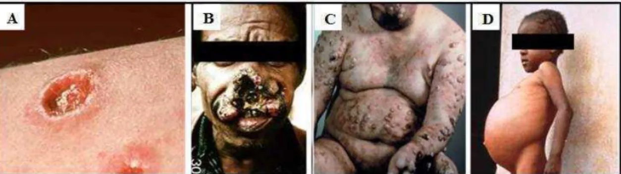 Figura  3:  Formas  clínicas  da  leishmaniose.  (A)  LC,  (B)  LMC,  (C)  LCD,  (D)  LV 