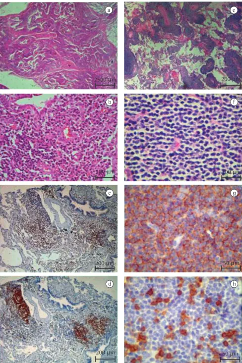 Figure 1 - (Panels a to d). Panoramic view of the histological pattern found in lymphoid interstitial pneumonia